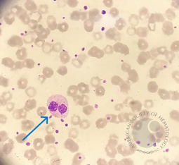 PSEUDO-PELGER-HUET ANAMOLY