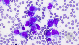 AML pCT with KAT6A::CREBBP fusion