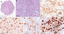 Classic Hodgkin lymphoma in the cerebellum: a rare site for a common disease