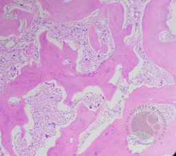 Primary myelofibrosis (PMF) with osteosclerotic progression 1