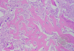 Primary myelofibrosis (PMF) with osteosclerotic progression 2