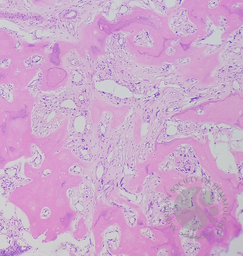 Primary myelofibrosis (PMF) with osteosclerotic progression 3