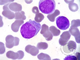 Blasts in AML