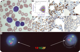 A small B-cell leukemia/lymphoma with weak to negative expression of CD5