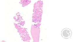 Figure 1 -Bone marrow biopsy (2x)