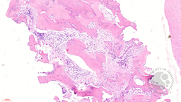 Figure 2 - Bone marrow biopsy (10x)