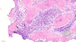 Figure 3 -Bone marrow biopsy (20x)