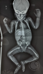 Figure 4 - Infantogram