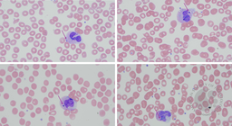 Howell-Jolly Body-like neutrophilic inclusions in heart transplant patient
