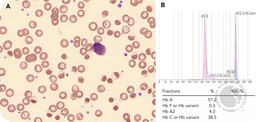 Severe oxidant hemolysis in a child with G6PD deficiency and Hb C trait