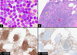 Simultaneous Occurrence of Chronic Lymphocytic Leukemia and High-Grade Therapy-Related Myeloid Neoplasm: Morphologic and Immunohistochemical Features
