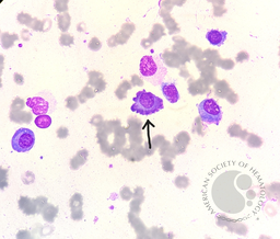Flame Cells in Bone Marrow Aspirate (2)