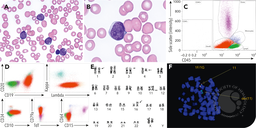 B-lymphoblastic leukemia with KMT2A rearrangement with mature B-cell phenotype and surface λ light-chain restriction