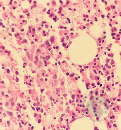 Histoplasma capsulatum in a bone marrow biopsy