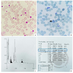 HbH disease