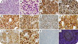 A rare phenotype of peripheral T-cell lymphoma, NOS: coexpression of CD15, CD20, and T follicular helper markers in a DUSP22 case