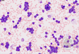 Acute Lymphoblastic Leukemia with cup-shaped blast morphology 1