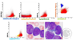 Acute Lymphoblastic Leukemia with cup-shaped blast morphology 2