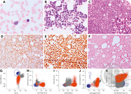 Secondary blastoid plasma cell leukemia: can an old dog learn new tricks?