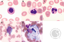 Hematological aspects of colchicine poisoning