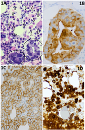 Bone Marrow Biopsy Showing Concurrent Multiple Myeloma and Prostate Carcinoma: Morphologic and Immunohistochemical Features