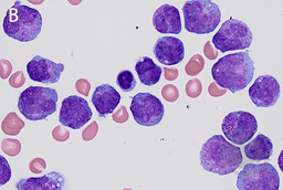 Extramedullary relapse of acute promyelocytic leukemia in cerebrospinal fluid 2