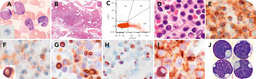 Immunoglobulin-containing vacuoles in CLL