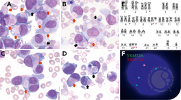 Atypical cytoplasmic inclusions and erythrophagocytosis in acute myeloid leukemia with KMT2A::MLLT3 and U2AF1 mutation