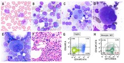 Chronic myelomonocytic leukemia with KRAS mutation