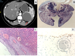 Mesothelial splenic cyst: An insight into rare phenomenon