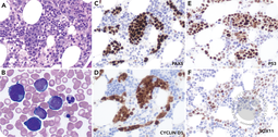 Intrasinusoidal pleomorphic mantle cell lymphoma mimicking intravascular large B-cell lymphoma