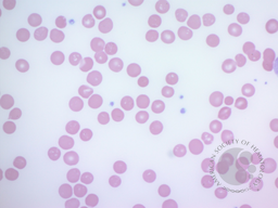 Vacuolated Erythrocytes Figure 1(a)