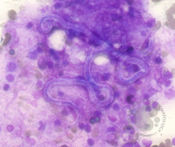 Microfilaria: A Parasite in Bone Marrow