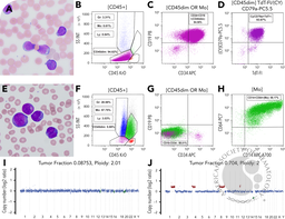 Lineage switch from KMT2A-rearranged congenital B-ALL to AML in an infant: a genomic perspective