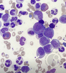 Chronic myeloid leukaemia 2