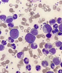 Chronic myeloid leukaemia 3