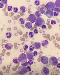 Chronic myeloid leukaemia 4