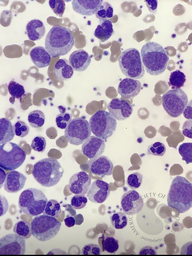 Chronic myeloid leukaemia 5