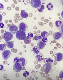 Chronic myeloid leukaemia 1