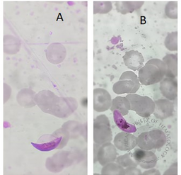 Gametocytes of Plasmodium falciparum