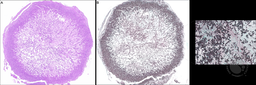 Endobronchial Aspergillosis Following Allogeneic Hematopoietic Cell Transplantation