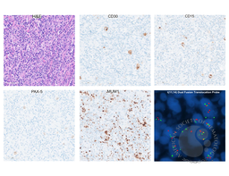 Classic Hodgkin Lymphoma with IGH::CCND1 Rearrangement: Evidence of Clonal Relationship with Preceding Mantle Cell Lymphoma