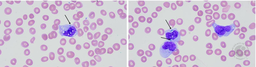 Blue-Green Inclusions are Correlated with Acute Liver Injury in a Case of Acute Myeloid Leukemia