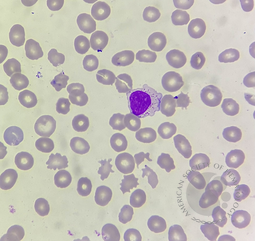 Large granular lymphocyte
