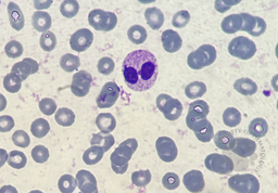 Pseudo-Pelger-Huet neutrophil presence due to reactive leukocytosis caused by infection 1