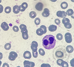 Pseudo-Pelger-Huet neutrophil presence due to reactive leukocytosis caused by infection 2