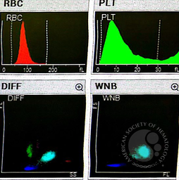 Pseudo-Pelger-Huet neutrophil presence due to reactive leukocytosis caused by infection 3