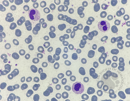 Pseudo-Pelger-Huet neutrophil presence due to reactive leukocytosis caused by infection 4