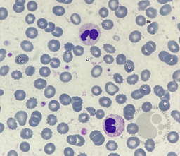 Pseudo-Pelger-Huet neutrophil presence due to reactive leukocytosis caused by infection 5