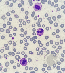 Pseudo-Pelger-Huet neutrophil presence due to reactive leukocytosis caused by infection 6